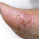 Waspada Pengidap Diabetes Terkena Penyakit Tinea Pedis halodoc