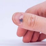 What Happens If a Nail Bed Injury is Left Untreated